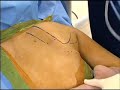 Dr. Peter Millett treating a Snapping Scapula