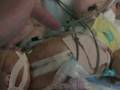 Andrew's Journey - Transposition of the Great Arteries