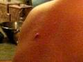 My First Zit