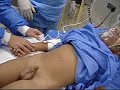 Anestesia Epidural Caudal en Niño de 3 años Anestesia Epidural Caudal en Niño de 3 años