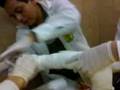 Yeso braquio palmar