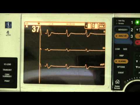 how to treat 3rd degree heart block