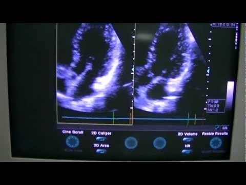 how to measure ejection fraction ultrasound