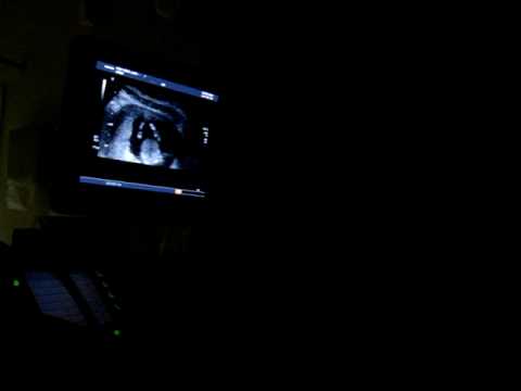 how to decide to do an amniocentesis
