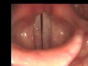 Laryngology 101 - Vocal nodules Laryngology 101 - Vocal nodules