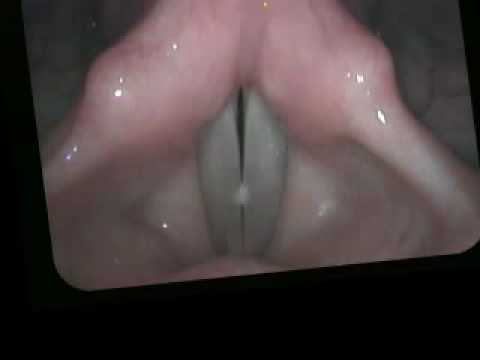 how to cure vocal nodules