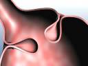 StomaphyX™ - Gastric Bypass Revision from Fort Worth LAPBAND
