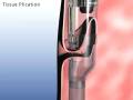 StomaphyX™ - Gastric Bypass Revision from Fort Worth LAPBAND