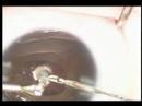 25g baby congenital cataract surgery by Uday Devgan MD 25g baby congenital cataract surgery by Uday Devgan MD