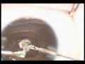 Surgery Of Congenital Cataract Surgery Of Congenital Cataract