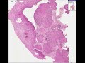 Histopathology Cervix- -Squamous cell carcinoma