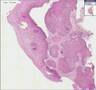 Histopathology Cervix- -Squamous cell carcinoma