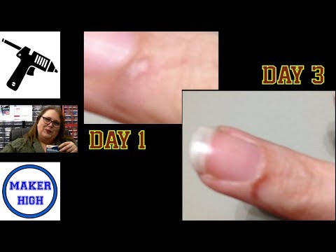 how to treat ice burn