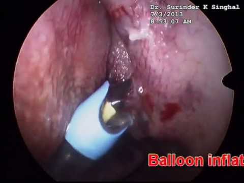 how to drain upper sinus cavity