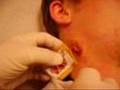 STAPH INFECTION
