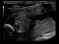 Twins Ultrasound Week 19 B/G Fraternal -Video 2 of 3