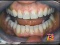 porcelain veneers for stained teeth