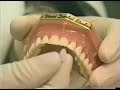 porcelain veneers for stained teeth