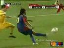 Ronaldinho Complication - Barcelona