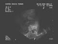 Prostate KTP-laser ablation ultrasound monitoring