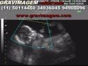 GRAVIMAGEM 90 (ULTRA-SOM DE GRAVIDEZ 3D 4D 18 SEMANAS) GRAVIMAGEM 90 (ULTRA-SOM DE GRAVIDEZ 3D 4D 18 SEMANAS)