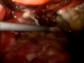 Sleeve Gastrectomy Leak.mp4
