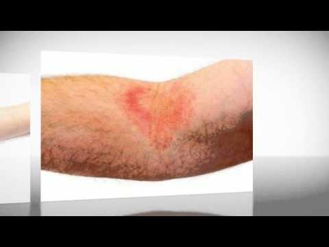 how to treat varicose eczema