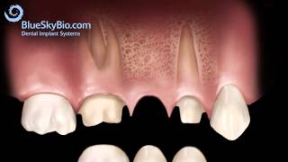 Dental Bridge