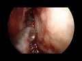Skull Base Reconstruction - Transnasal Repair Skull Base Reconstruction - Transnasal Repair