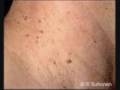 Are Your Looking For A Natural Mole, Wart, and Skin Tag Remover