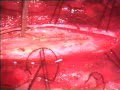 Lipoma Of The Spinal Cord Lipoma Of The Spinal Cord