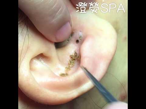 Extracción de un punto negro en la oreja
