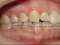 Bruxismo: Tratamento integrado – Ortodontia e estética