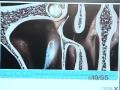 Minimally Invasive Sinus Surgery - Interview with a Surgeon Minimally Invasive Sinus Surgery - Interview with a Surgeon