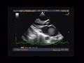 Mobile clot inside left atrium Mobile clot inside left atrium