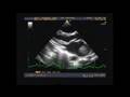 Mobile clot inside left atrium