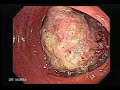 Cáncer del Colon VideoColonoscopia por el Dr. Murra Saca