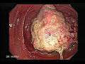 C�ncer del Colon VideoColonoscopia por el Dr. Murra Saca