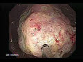 Cáncer del Colon VideoColonoscopia por el Dr. Murra Saca