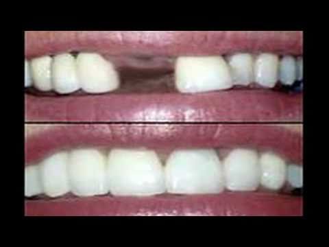 how to whiten permanent bridges