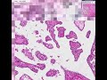 Histopathology Thyroid--Hashimoto thyroiditis, papillary car