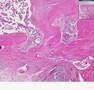 Histopathology Thyroid--Hashimoto thyroiditis, papillary car