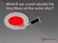 The Regenexx procedure used to treat disc bulges. The Regenexx procedure used to treat disc bulges.