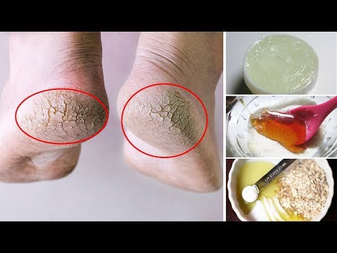 How to Get Rid of Dry Feet and Cracked Heels Fast | Natural Cures