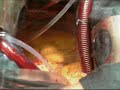 Kammerflimmern + EKG am offenen Herz