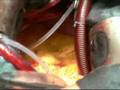 Kammerflimmern + EKG am offenen Herz ( Ventricular Fibrillation+ECG Monitoring)