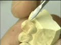 Posterior jacket crown -Composite build-up procedure