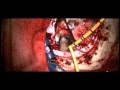 Transcallosal approach for third ventriculostomy and removal of midbrain cavernous malformation