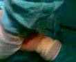 Cirugia de mioma uterino