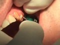 Prosthetic Video